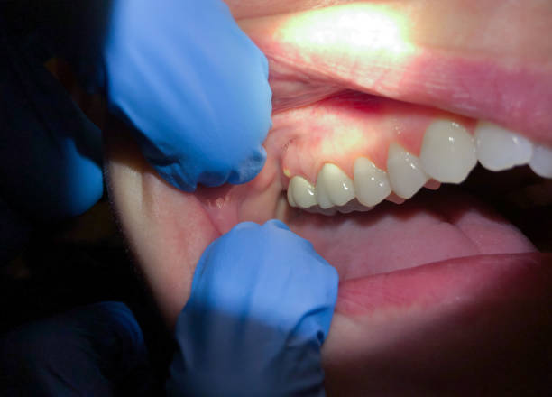 Best Emergency Wisdom Teeth Removal in Biltmore, TN